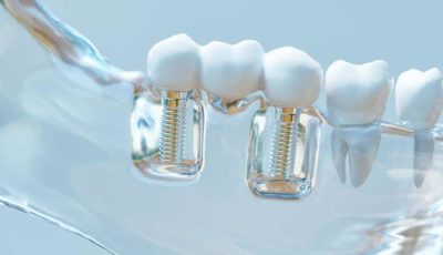 8 consejos que debes tener en cuenta antes de hacerte un implante dental